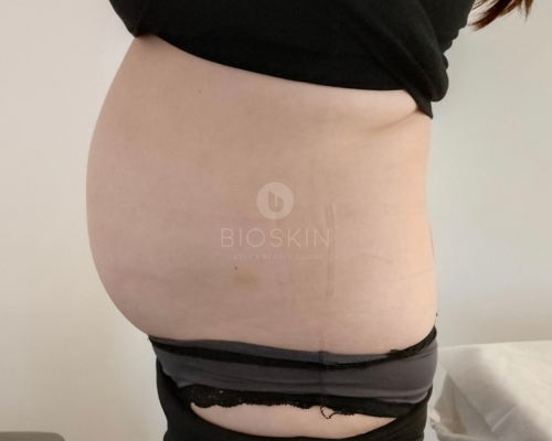 Ultrahangos zsírbontás eredmények előtte-utána képek 15 Before image