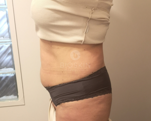 Ultrahangos zsírbontás eredmények előtte-utána képek 17 Before image