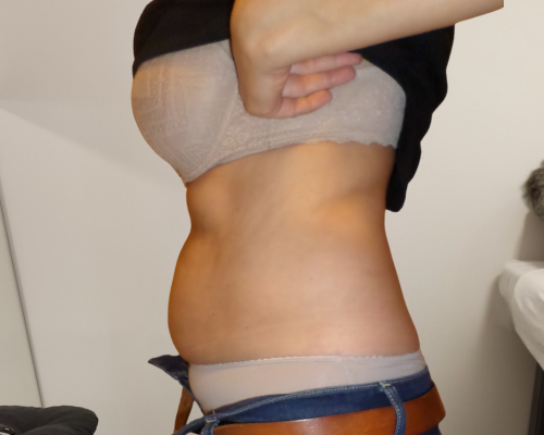 Ultrahangos zsírbontás eredmények előtte-utána képek 27 Before image