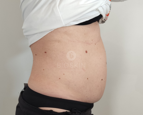 Ultrahangos zsírbontás eredmények előtte-utána képek 23 Before image