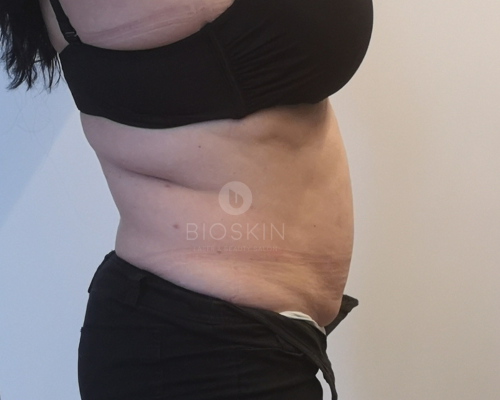 Ultrahangos zsírbontás eredmények előtte-utána képek 25 Before image